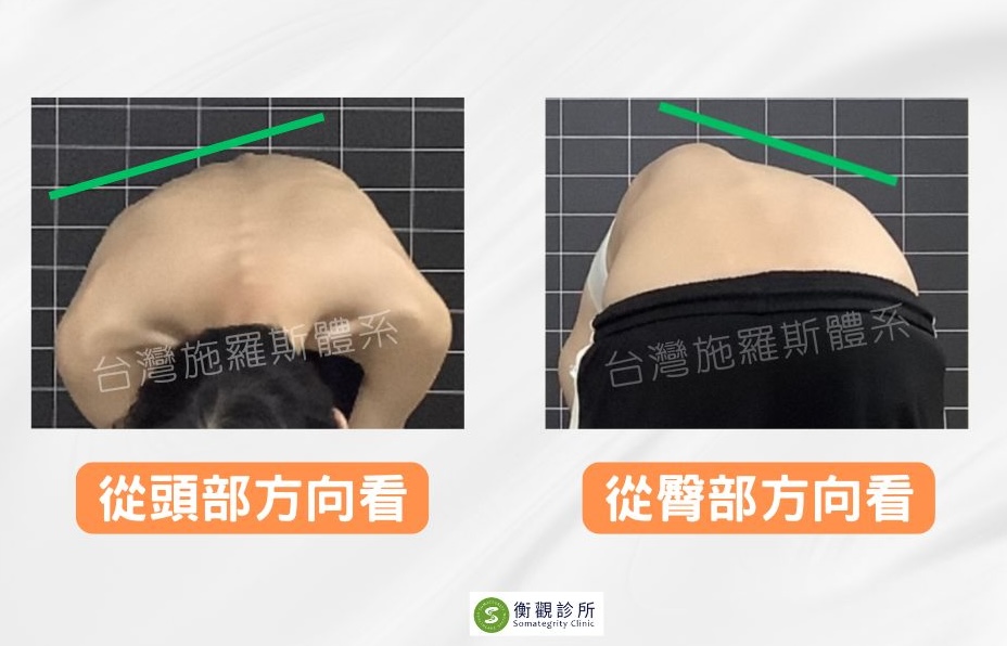 台灣施羅斯脊椎側彎亞當前彎檢測