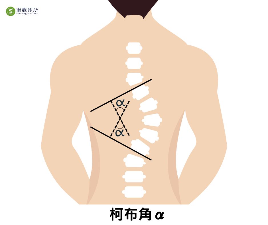 衡觀診所脊椎側彎Cobb角