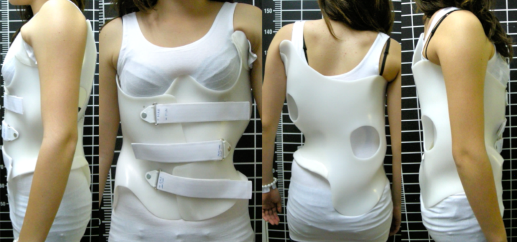 Different views of the Rigo-Chêneau brace