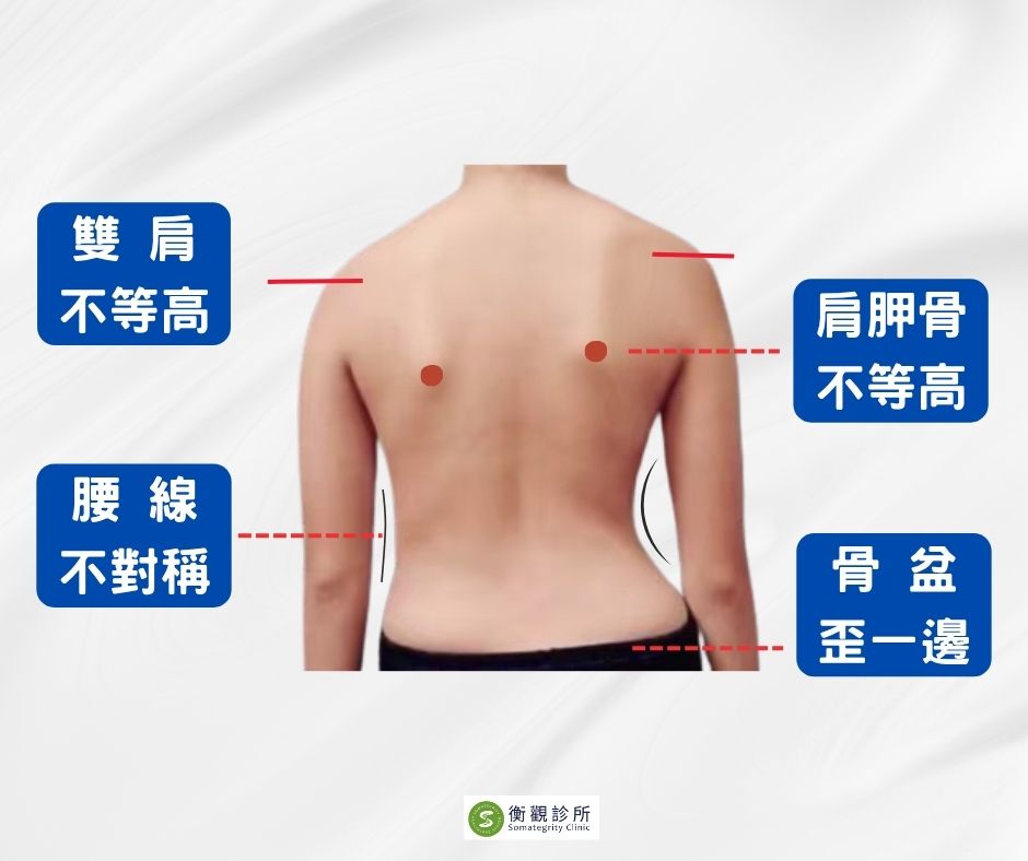 脊椎側彎體態特徵